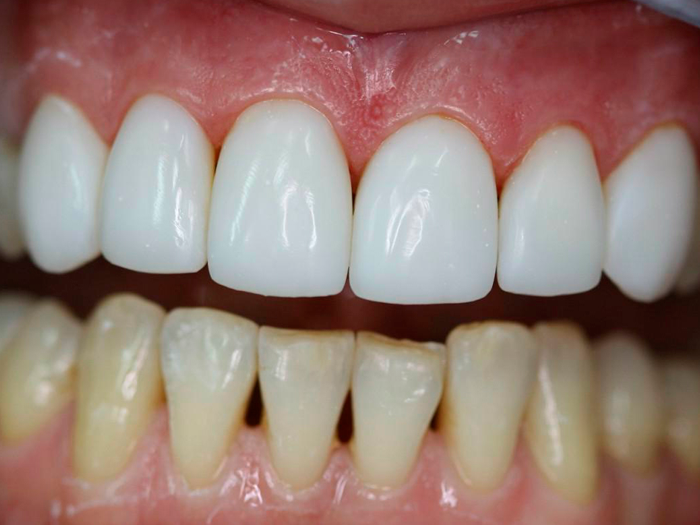 Что такое зубные виниры