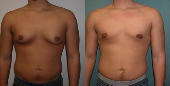 гинекомастия слева и грудь после лечения справа