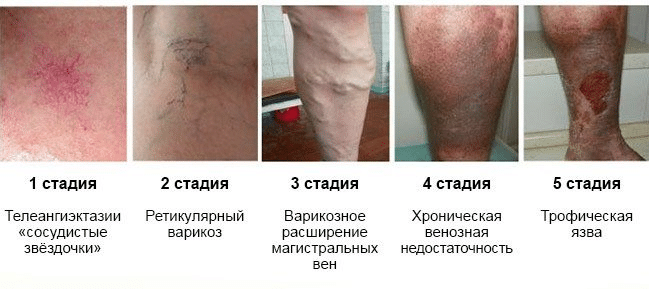 Варикозное расширение вен на ногах, лечение и профилактика современной чумы