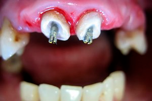 Что такое зубной штифт и как его устанавливают