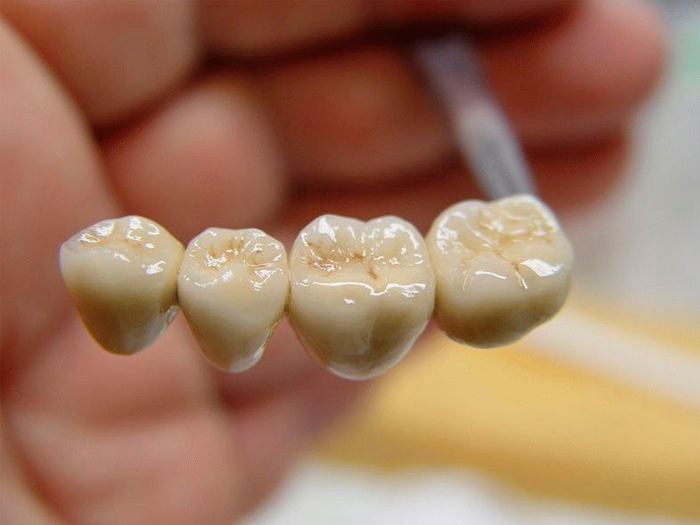 Виды зубных мостов как выбрать