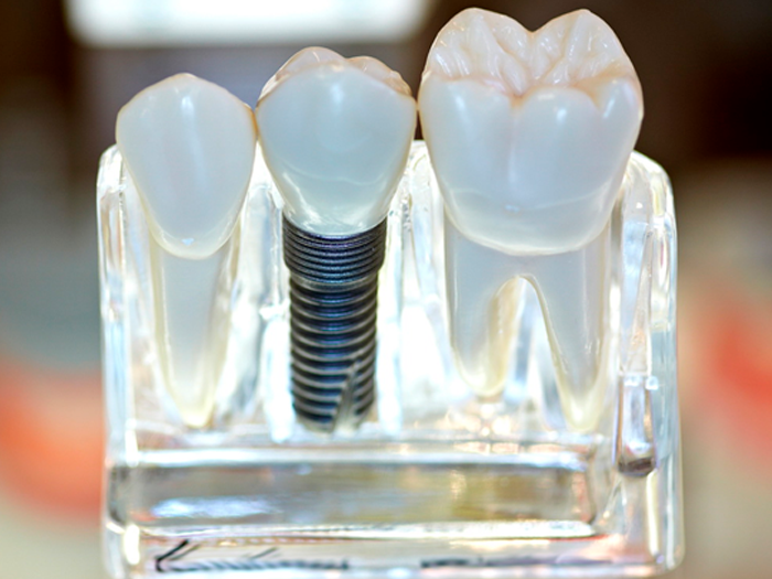 Виды и преимущества зубных коронок