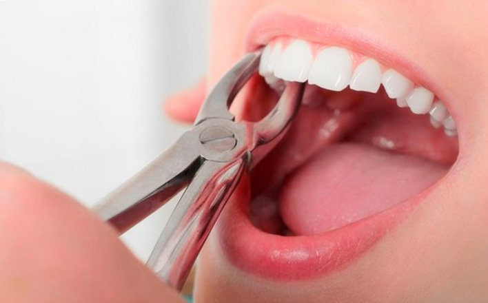 как удалить зуб самостоятельно