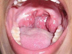 лечение кашля при тонзиллите