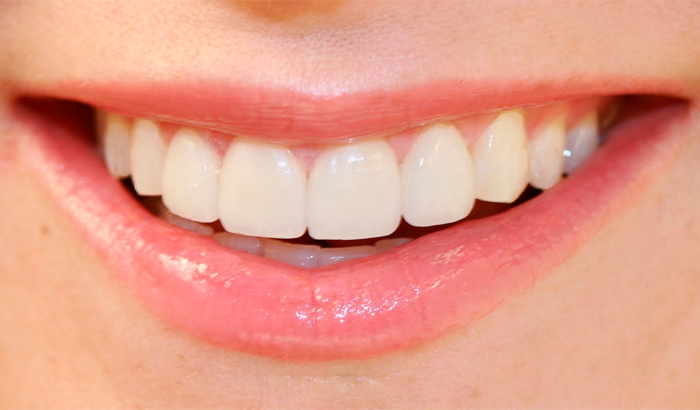 Ультразвуковая чистка зубов фото до и после