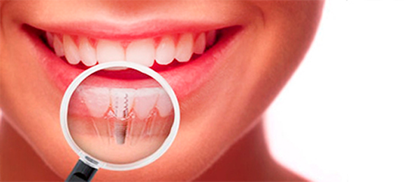 Как происходит установка зубных имплантов?