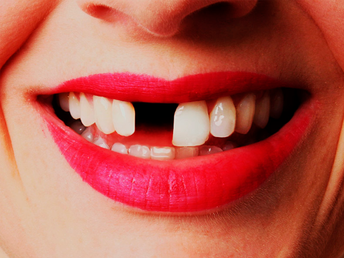 Адентия полное или частичное отсутствие зубов