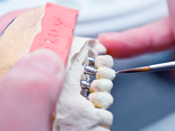 Как восстановить сломанный зуб