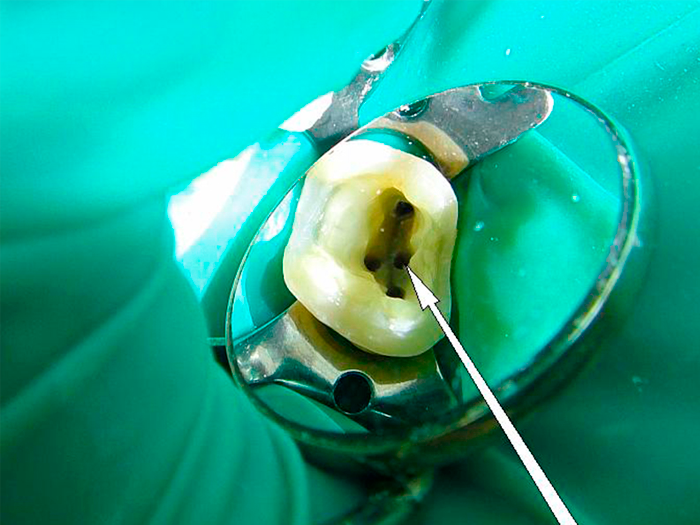 Боль в зубе после пломбирования корневого канала