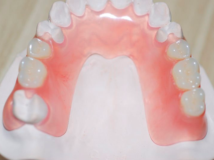 Этапы и виды съемного протезирования зубов
