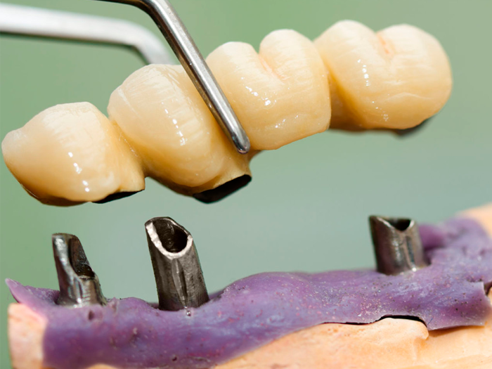 Этапы и виды съемного протезирования зубов