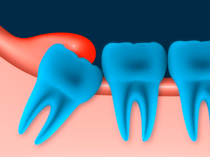 Как унять сильную зубную боль?