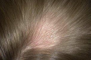 Заболевание кожи головы и волос