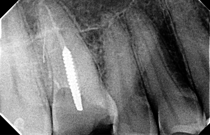 Почему болит зуб при нажатии после удаления нерва