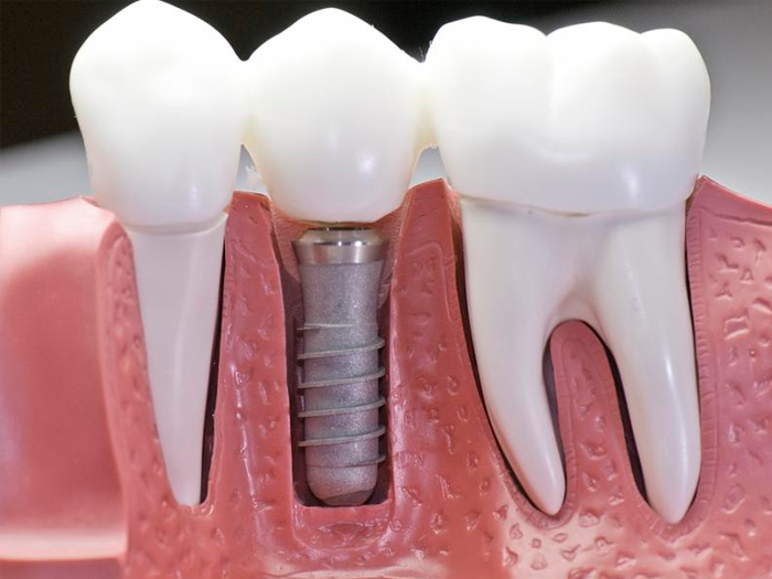 Как происходит установка зубных имплантов?