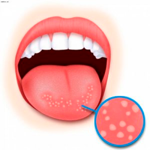 Почему появляется кандидоз во рту и как его лечить