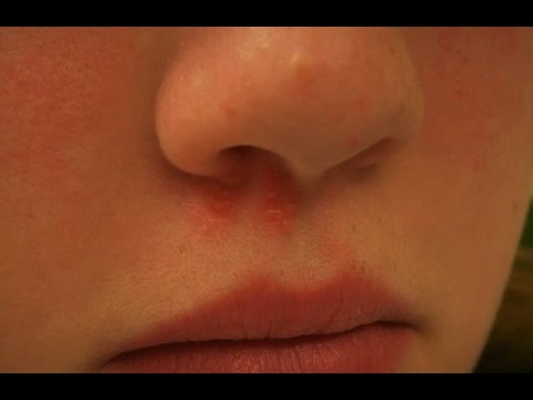 Характеристика герпеса в носу