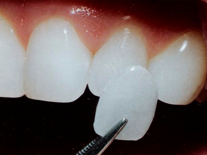 Что такое зубные виниры