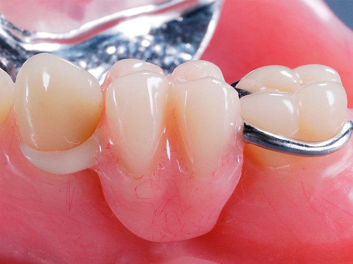 Льготы на протезирование зубов