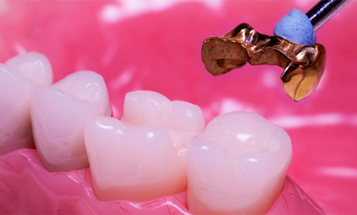 Как восстановить сломанный зуб