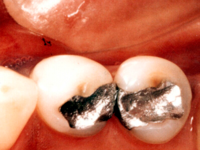 Виды зубных пломб какой материал лучше?