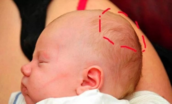 Гематома на голове у новорожденного после родов