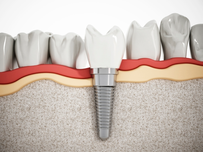 Симптомы отторжения зубного импланта