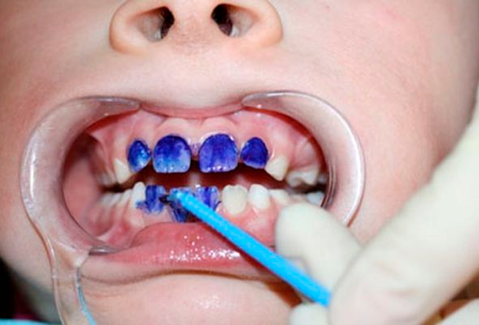 Простое и глубокое фторирование зубов