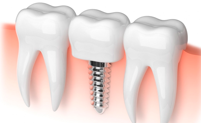 Симптомы отторжения зубного импланта