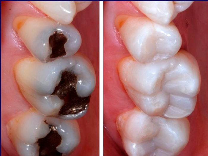 Виды зубных пломб какой материал лучше?