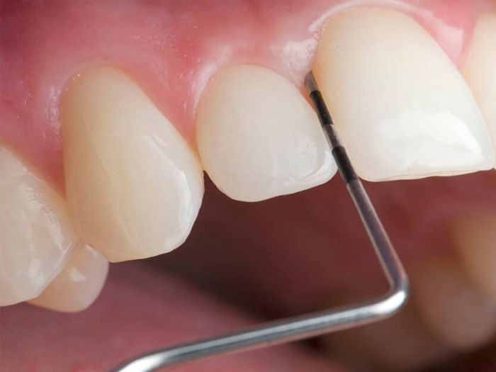 Как удалить зубной камень народными средствами