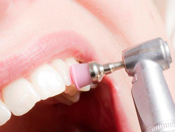 Удаление твердого зубного налета
