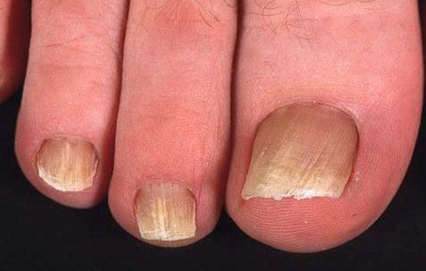 Онихомикоз ногтей: лечение. Препараты недорогие, но эффективные