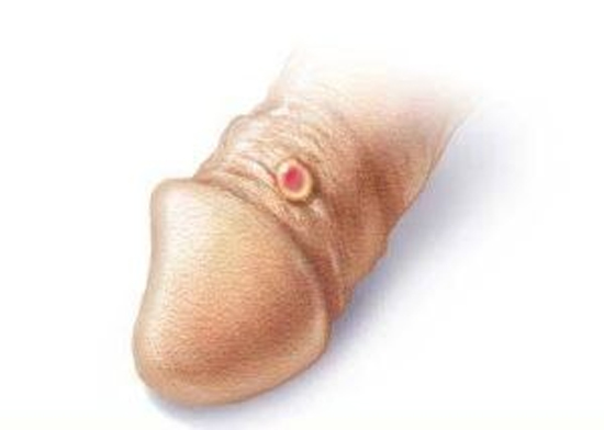 Фото 2. Внешний вид твердого шанкра на головке пениса при сифилисе.