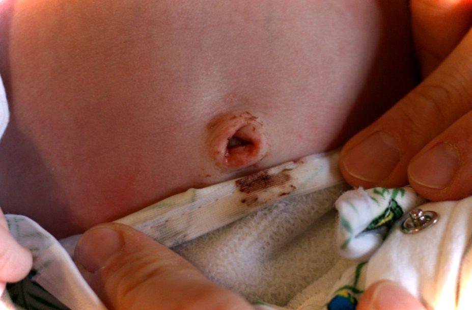 Кровотечения у новорожденных: как остановить кровь у младенца