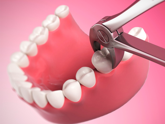 Как происходит удаление зубов