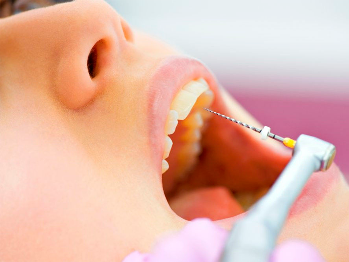 Лечение каналов зуба чистка и пломбирование