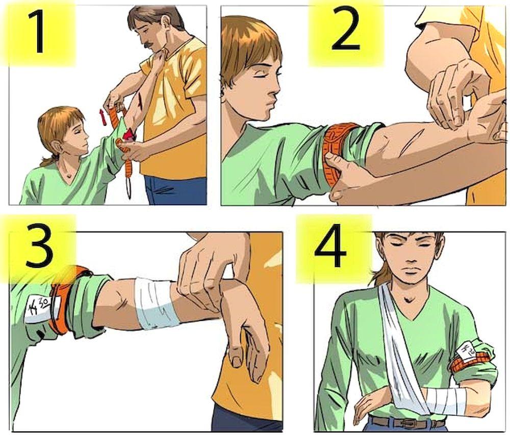 Первая помощь при переломе руки