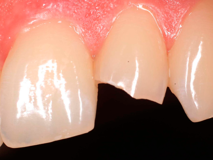Методы восстановления зубов