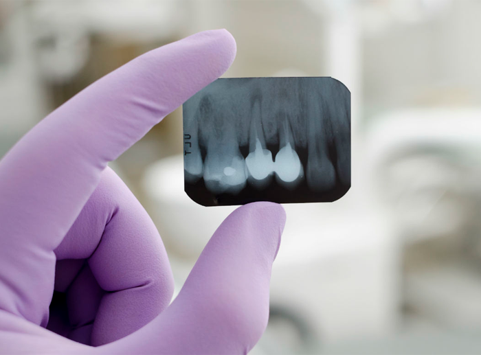 Рентген в стоматологии ортопантомограмма