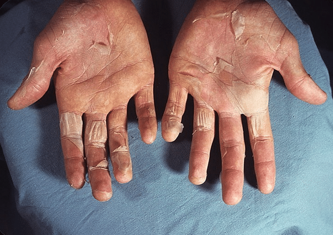 Если трескается кожа на пальцах рук: причины и лечение