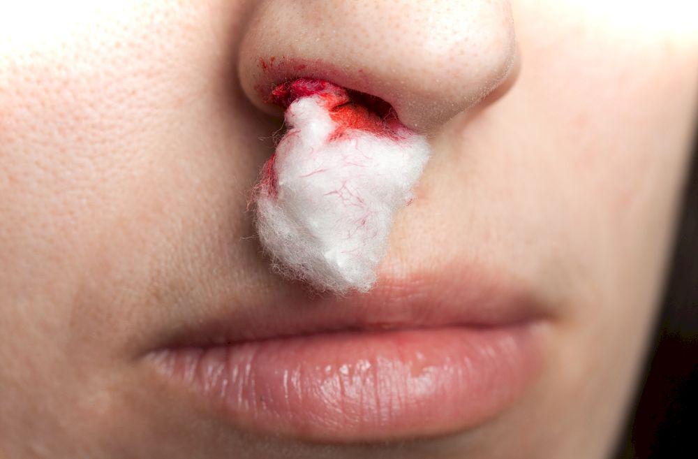 Как быстро остановить кровь из носа