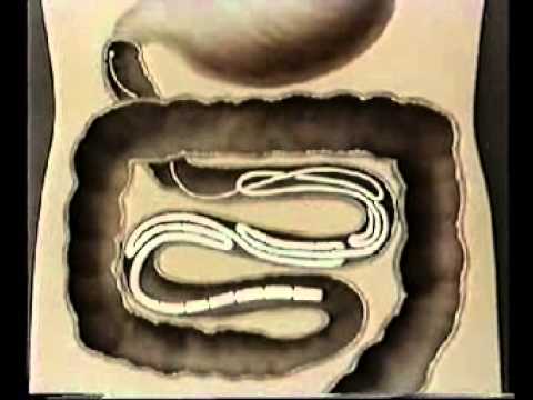 Что такое гельминтоз, вызванный ленточными червями?