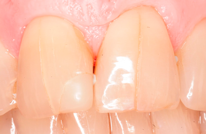 Как убрать трещины на зубной эмали