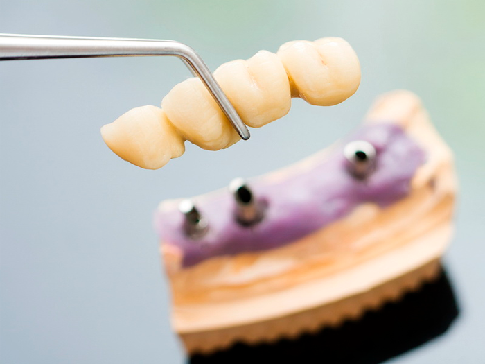 Рейтинг лучших зубных имплантов и клиник