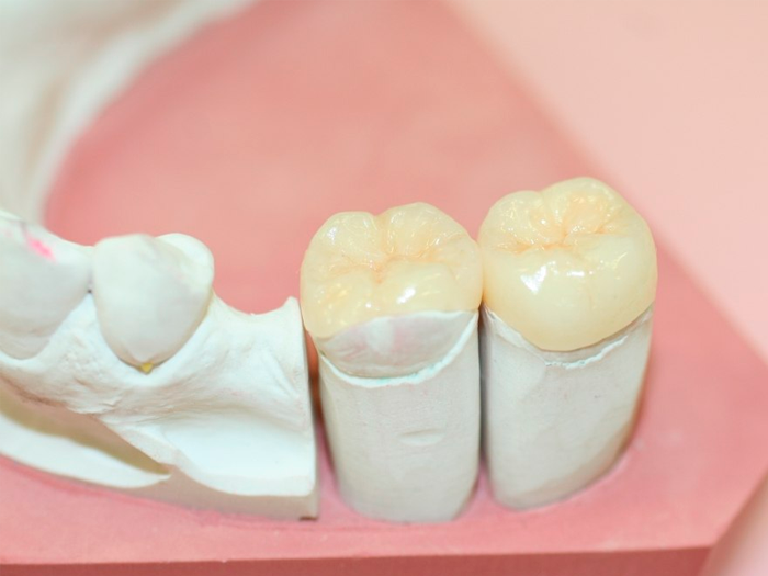 Виды и преимущества зубных вкладок