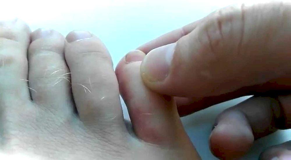 Что делать, если сломан палец на ноге?