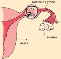 эмбрион в маточной трубе