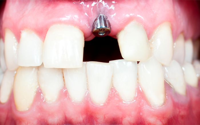 Адентия полное или частичное отсутствие зубов