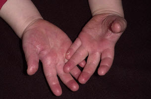 У ребенка на пальчиках ног шелушится кожа. Что это может быть?